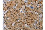 The image on the left is immunohistochemistry of paraffin-embedded Human liver cancer tissue using CSB-PA100659(BTLA Antibody) at dilution 1/30, on the right is treated with fusion protein. (Original magnification: 