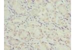 Immunohistochemistry of paraffin-embedded human gastric cancer using CSB-PA10079A0Rb at dilution of 1:100
