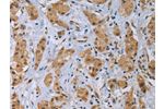 The image on the left is immunohistochemistry of paraffin-embedded Human breast cancer tissue using CSB-PA100844(CLEC1A Antibody) at dilution 1/40, on the right is treated with fusion protein. (Original magnification: 