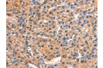 The image on the left is immunohistochemistry of paraffin-embedded Human liver cancer tissue using CSB-PA101358(DOCK1 Antibody) at dilution 1/25, on the right is treated with synthetic peptide. (Original magnification: 