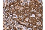 The image on the left is immunohistochemistry of paraffin-embedded Human gastic cancer tissue using CSB-PA102201(GAD1 Antibody) at dilution 1/40, on the right is treated with synthetic peptide. (Original magnification: 