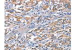 The image on the left is immunohistochemistry of paraffin-embedded Human thyroid cancer tissue using CSB-PA102499(CDH5 Antibody) at dilution 1/30, on the right is treated with synthetic peptide. (Original magnification: 