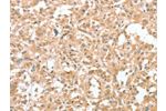 The image on the left is immunohistochemistry of paraffin-embedded Human thyroid cancer tissue using CSB-PA102580(CIAPIN1 Antibody) at dilution 1/60, on the right is treated with fusion protein. (Original magnification: 