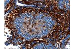 The image on the left is immunohistochemistry of paraffin-embedded Human cervical cancer tissue using CSB-PA102646(CNGA2 Antibody) at dilution 1/25, on the right is treated with fusion protein. (Original magnification: 