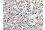 The image on the left is immunohistochemistry of paraffin-embedded Human thyroid cancer tissue using CSB-PA102745(ACTR2 Antibody) at dilution 1/30, on the right is treated with fusion protein. (Original magnification: 