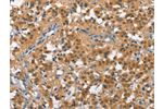 The image on the left is immunohistochemistry of paraffin-embedded Human thyroid cancer tissue using CSB-PA103046(CUL7 Antibody) at dilution 1/50, on the right is treated with fusion protein. (Original magnification: 