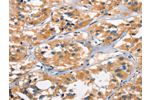 The image on the left is immunohistochemistry of paraffin-embedded Human thyroid cancer tissue using CSB-PA103047(AHR Antibody) at dilution 1/50, on the right is treated with synthetic peptide. (Original magnification: 