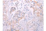 The image on the left is immunohistochemistry of paraffin-embedded Human breast cancer tissue using CSB-PA103066(ADAMTS14 Antibody) at dilution 1/50, on the right is treated with synthetic peptide. (Original magnification: 