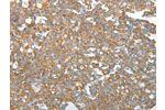 The image on the left is immunohistochemistry of paraffin-embedded Human breast cancer tissue using CSB-PA103174(GEMIN2 Antibody) at dilution 1/40, on the right is treated with synthetic peptide. (Original magnification: 