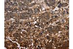 The image on the left is immunohistochemistry of paraffin-embedded Human liver cancer tissue using CSB-PA103410(FBP2 Antibody) at dilution 1/40, on the right is treated with fusion protein. (Original magnification: 