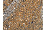 The image on the left is immunohistochemistry of paraffin-embedded Human cervical cancer tissue using CSB-PA103488(CIB1 Antibody) at dilution 1/30, on the right is treated with synthetic peptide. (Original magnification: 