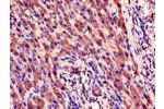 Immunohistochemistry of paraffin-embedded human liver cancer using CSB-PA10349A0Rb at dilution of 1:100