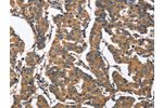 The image on the left is immunohistochemistry of paraffin-embedded Human breast cancer tissue using CSB-PA103726(BNIP2 Antibody) at dilution 1/50, on the right is treated with synthetic peptide. (Original magnification: 