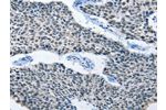 The image on the left is immunohistochemistry of paraffin-embedded Human lung cancer tissue using CSB-PA104194(ELAVL1 Antibody) at dilution 1/50, on the right is treated with fusion protein. (Original magnification: 
