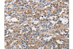 The image on the left is immunohistochemistry of paraffin-embedded Human thyroid cancer tissue using CSB-PA104246(ALCAM Antibody) at dilution 1/15, on the right is treated with synthetic peptide. (Original magnification: 