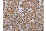 The image on the left is immunohistochemistry of paraffin-embedded Human thyroid cancer tissue using CSB-PA104519(ACVR2A Antibody) at dilution 1/20, on the right is treated with synthetic peptide. (Original magnification: 