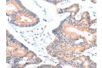 The image on the left is immunohistochemistry of paraffin-embedded Human colon cancer tissue using CSB-PA104599(AOC1 Antibody) at dilution 1/15, on the right is treated with fusion protein. (Original magnification: 