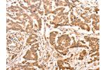 The image on the left is immunohistochemistry of paraffin-embedded Human colon cancer tissue using CSB-PA104784(ACO2 Antibody) at dilution 1/30, on the right is treated with synthetic peptide. (Original magnification: 