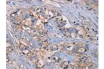The image on the left is immunohistochemistry of paraffin-embedded Human breast cancer tissue using CSB-PA104968(GHITM Antibody) at dilution 1/30, on the right is treated with fusion protein. (Original magnification: 