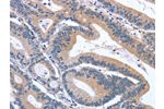 The image on the left is immunohistochemistry of paraffin-embedded Human colon cancer tissue using CSB-PA105485(GDF11 Antibody) at dilution 1/30, on the right is treated with synthetic peptide. (Original magnification: 