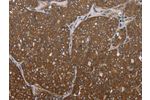 The image on the left is immunohistochemistry of paraffin-embedded Human ovarian cancer tissue using CSB-PA105517(FOLH1B Antibody) at dilution 1/30, on the right is treated with synthetic peptide. (Original magnification: 