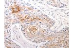 The image on the left is immunohistochemistry of paraffin-embedded Human esophagus cancer tissue using CSB-PA105805(DFFB Antibody) at dilution 1/30, on the right is treated with synthetic peptide. (Original magnification: 