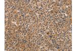 The image on the left is immunohistochemistry of paraffin-embedded Human liver cancer tissue using CSB-PA105838(CDK11A/CDK11B Antibody) at dilution 1/40, on the right is treated with synthetic peptide. (Original magnification: 