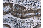 The image on the left is immunohistochemistry of paraffin-embedded Human colon cancer tissue using CSB-PA105996(CFLAR Antibody) at dilution 1/20, on the right is treated with synthetic peptide. (Original magnification: 