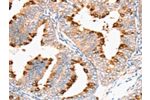 The image on the left is immunohistochemistry of paraffin-embedded Human cervical cancer tissue using CSB-PA106123(DNMT1 Antibody) at dilution 1/35, on the right is treated with synthetic peptide. (Original magnification: 