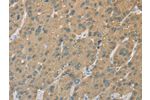The image on the left is immunohistochemistry of paraffin-embedded Human liver cancer tissue using CSB-PA106326(CYP2C9 Antibody) at dilution 1/50, on the right is treated with fusion protein. (Original magnification: 