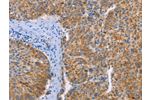 The image on the left is immunohistochemistry of paraffin-embedded Human liver cancer tissue using CSB-PA106672(FGL1 Antibody) at dilution 1/25, on the right is treated with fusion protein. (Original magnification: 