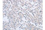 The image on the left is immunohistochemistry of paraffin-embedded Human thyroid cancer tissue using CSB-PA106715(AGAP2 Antibody) at dilution 1/60, on the right is treated with synthetic peptide. (Original magnification: 