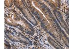 The image on the left is immunohistochemistry of paraffin-embedded Human colon cancer tissue using CSB-PA106926(ETV7 Antibody) at dilution 1/30, on the right is treated with fusion protein. (Original magnification: 