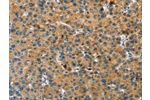 The image on the left is immunohistochemistry of paraffin-embedded Human liver cancer tissue using CSB-PA106951(GNB2L1 Antibody) at dilution 1/20, on the right is treated with fusion protein. (Original magnification: 