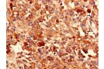 Immunocytochemistry analysis of human melanoma cancer using CSB-PA10715A0Rb at dilution of 1:100