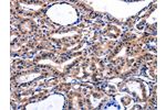 The image on the left is immunohistochemistry of paraffin-embedded Human thyroid cancer tissue using CSB-PA107393(FBN1 Antibody) at dilution 1/47, on the right is treated with synthetic peptide. (Original magnification: 