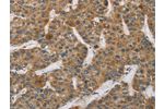 The image on the left is immunohistochemistry of paraffin-embedded Human liver cancer tissue using CSB-PA108423(DCTN2 Antibody) at dilution 1/50, on the right is treated with fusion protein. (Original magnification: 
