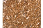 The image on the left is immunohistochemistry of paraffin-embedded Human gastic cancer tissue using CSB-PA108593(DAB2IP Antibody) at dilution 1/40, on the right is treated with synthetic peptide. (Original magnification: 