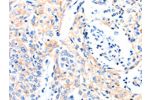 The image on the left is immunohistochemistry of paraffin-embedded Human cervical cancer tissue using CSB-PA108949(GAS6 Antibody) at dilution 1/8, on the right is treated with synthetic peptide. (Original magnification: 