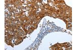 The image on the left is immunohistochemistry of paraffin-embedded Human breast cancer tissue using CSB-PA109108(CEACAM5 Antibody) at dilution 1/25, on the right is treated with synthetic peptide. (Original magnification: 