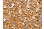 The image on the left is immunohistochemistry of paraffin-embedded Human liver cancer tissue using CSB-PA109166(CCS Antibody) at dilution 1/35, on the right is treated with synthetic peptide. (Original magnification: 