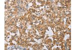 The image on the left is immunohistochemistry of paraffin-embedded Human thyroid cancer tissue using CSB-PA109402(CHI3L1 Antibody) at dilution 1/25, on the right is treated with fusion protein. (Original magnification: 