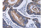 The image on the left is immunohistochemistry of paraffin-embedded Human colon cancer tissue using CSB-PA109564(CA4 Antibody) at dilution 1/30, on the right is treated with fusion protein. (Original magnification: 