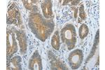The image on the left is immunohistochemistry of paraffin-embedded Human colon cancer tissue using CSB-PA109707(DNAJC3 Antibody) at dilution 1/30, on the right is treated with fusion protein. (Original magnification: 