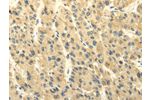 The image on the left is immunohistochemistry of paraffin-embedded Human liver cancer tissue using CSB-PA109776(ABCB7 Antibody) at dilution 1/20, on the right is treated with fusion protein. (Original magnification: 
