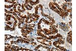 The image on the left is immunohistochemistry of paraffin-embedded Human thyroid cancer tissue using CSB-PA110327(ASB4 Antibody) at dilution 1/40, on the right is treated with fusion protein. (Original magnification: 