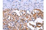 The image on the left is immunohistochemistry of paraffin-embedded Human thyroid cancer tissue using CSB-PA110575(ANO1 Antibody) at dilution 1/40, on the right is treated with synthetic peptide. (Original magnification: 