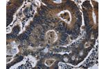 The image on the left is immunohistochemistry of paraffin-embedded Human colon cancer tissue using CSB-PA110763(DHCR7 Antibody) at dilution 1/20, on the right is treated with fusion protein. (Original magnification: 
