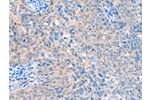 The image on the left is immunohistochemistry of paraffin-embedded Human cervical cancer tissue using CSB-PA110823(ACOX1 Antibody) at dilution 1/20, on the right is treated with fusion protein. (Original magnification: 