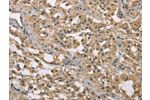 The image on the left is immunohistochemistry of paraffin-embedded Human thyroid cancer tissue using CSB-PA111089(DACH2 Antibody) at dilution 1/40, on the right is treated with fusion protein. (Original magnification: 